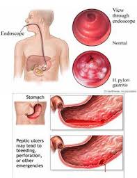 Người bị đau dạ dày nên kiêng ăn gì ?